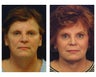Full Facial Rejuvenation
