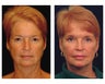 Full Facial Rejuvenation