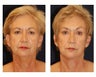 facelift, necklift