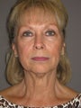 Facelift