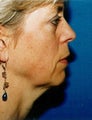 Facelift