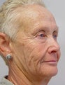 Facelift