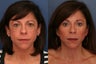 Composite facelift, midface lift, upper and lower blepharoplasty, browlift and cheek implants