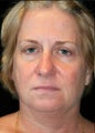 Facelift