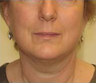 Facelift