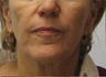 Facelift