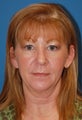 Facelift and Laser Resurfacing