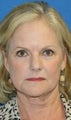 Short Incision Facelift and Lateral Browlift