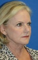 Short Incision Facelift and Lateral Browlift