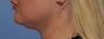 Facelift