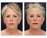 Facial Rejuvenation