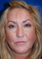 Facelift