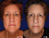 Facelift, necklift, upper & lower blepharoplasty, rhinoplasty
