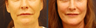 Facelift