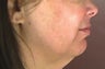 Facelift