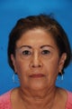 Face lift with upper and lower eyelid lift (blepharoplasty)