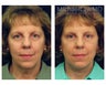 Facelift