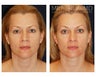Facial Rejuvenation