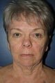 Facelift