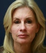 Facelift