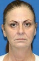 Facelift, Fat Transfer, Upper Bleph, Lower Eyelid Skin Pinch