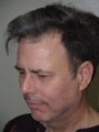 Midfacelift/Chin Implant/1800 Hair Grafts