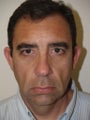 Facelift/Chin Implant