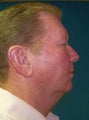 Facelift