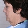 Facelift