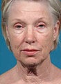 Facelift