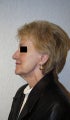 Facelift