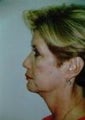Facelift