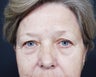 Facelift