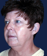 Facelift