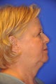 Facelift