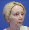 Facelift