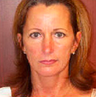 Facelift