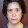 Facelift