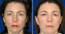 Facelift