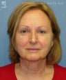 Facelift & Eyelid Surgery