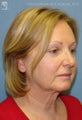Facelift & Eyelid Surgery