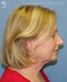 Facelift & Eyelid Surgery