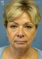 Facelift & Eyelid Surgery