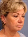 Facelift & Eyelid Surgery