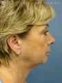 Facelift & Eyelid Surgery
