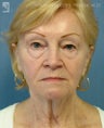 Facelift, Eyelid Surgery & Chin Implant