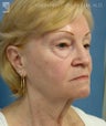 Facelift, Eyelid Surgery & Chin Implant
