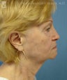 Facelift, Eyelid Surgery & Chin Implant