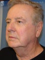 Facelift & Eyelid Surgery