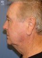 Facelift & Eyelid Surgery